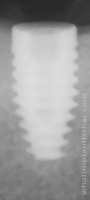 Radiograph of Engage