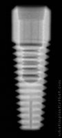 Radiograph of Integrity Implant