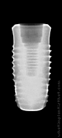Radiograph of INNO Internal