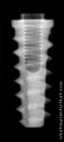 Radiograph of Tapered