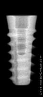 Radiograph of Tapered