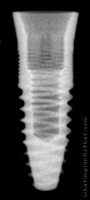 Radiograph of T3 Tissue Level