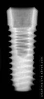Radiograph of Osstem SS III