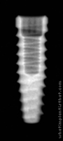 Radiograph of Tapered Internal Plus