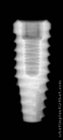 Radiograph of Tapered Internal Plus